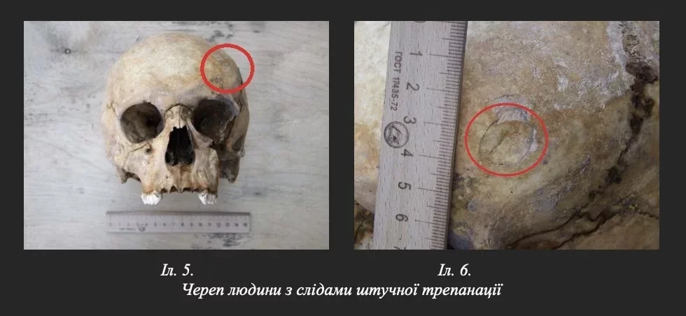 У Вінниці виявили череп зі слідами давньої трепанації на території Домініканського монастиря